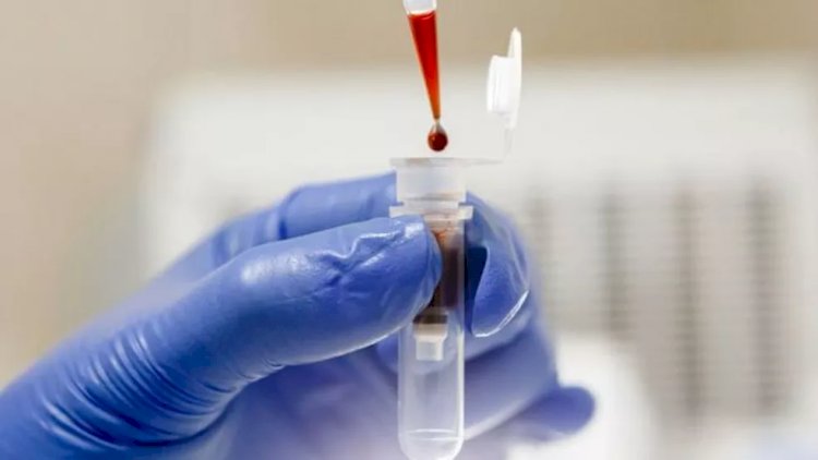 Biópsia líquida: o exame de sangue que permite acompanhar evolução do câncer