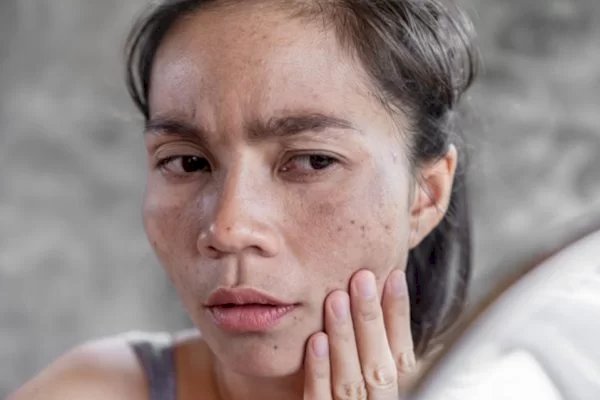 Melasma: sol do verão pode causar manchas escuras na pele